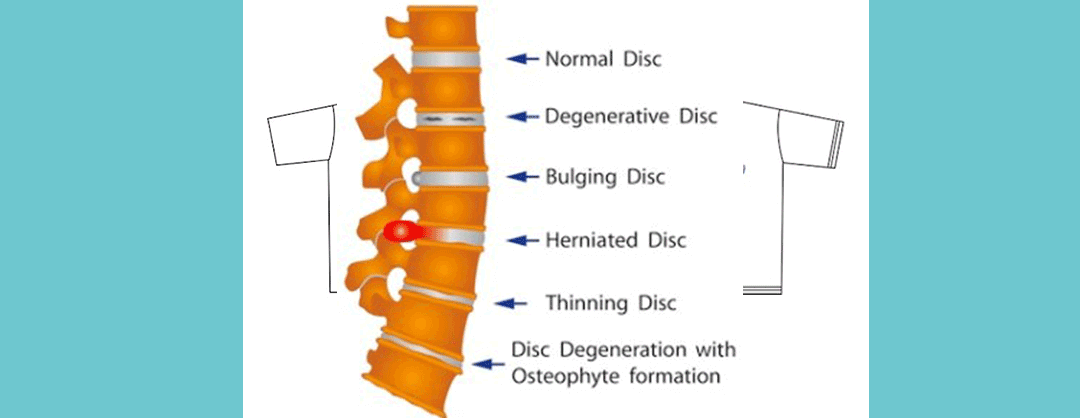 Rygsøjle med disc