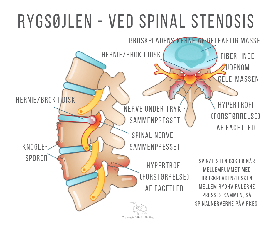 rygsøjlen stenosis